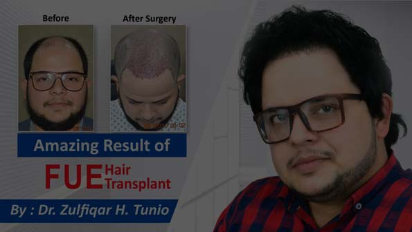 Best Hair Transplant in Pakistan