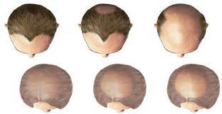 FUE Hair Transplant